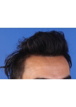 After Hair Transplant&nbsp;Front